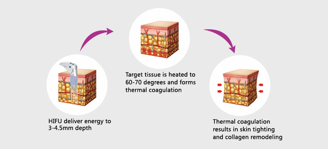 How HIFU Treatment Works