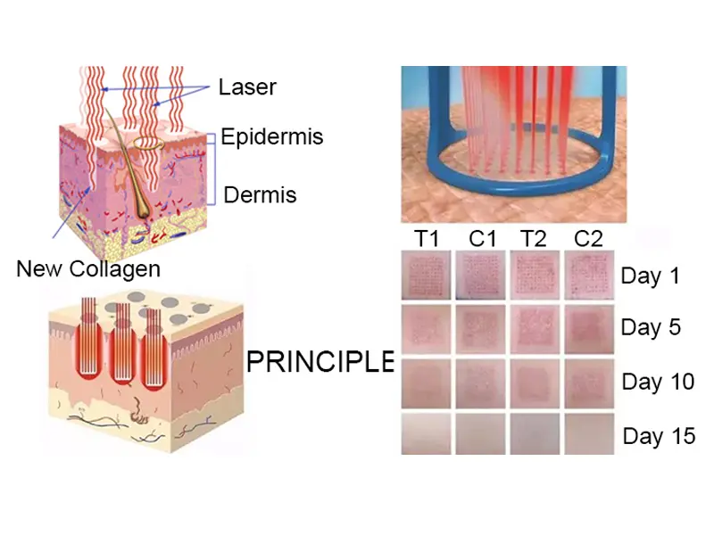 How does Co2 Fractional Laser work?
