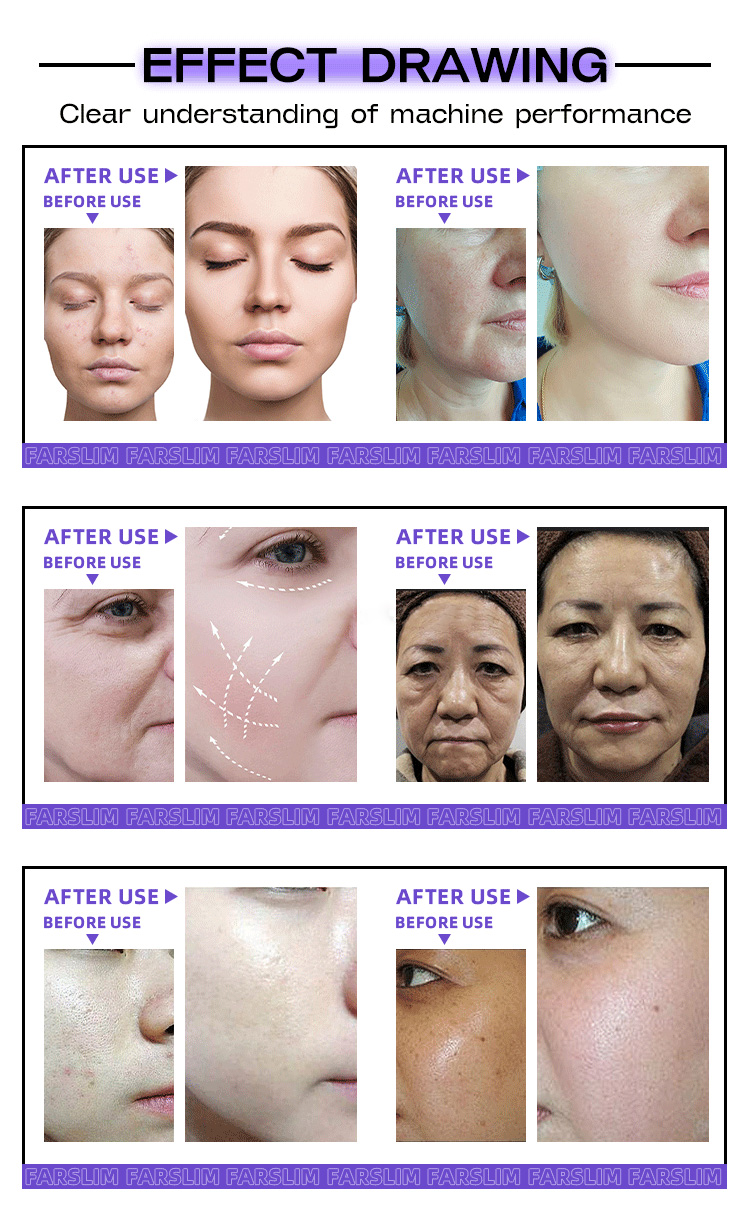Portable of 5-in-1 ICE HIFU Machine Before & After