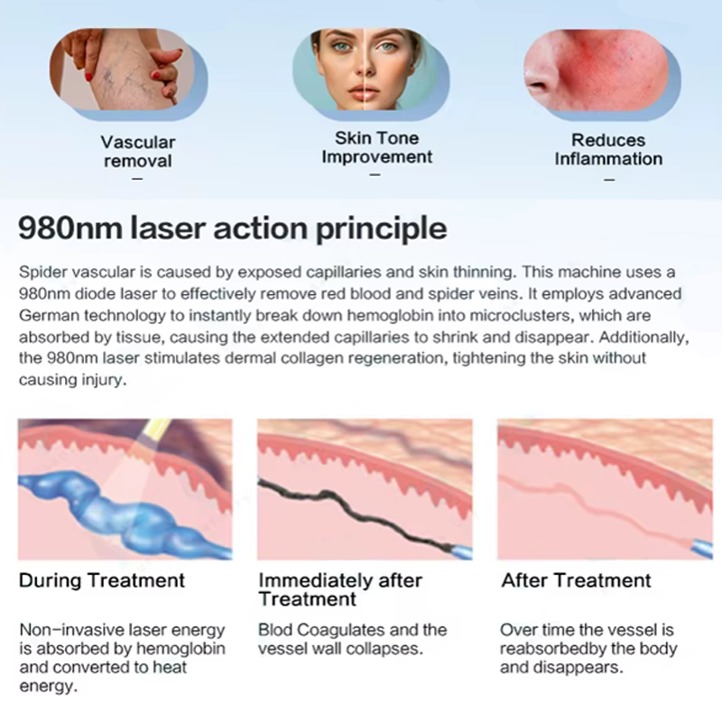 980nm laser action principle