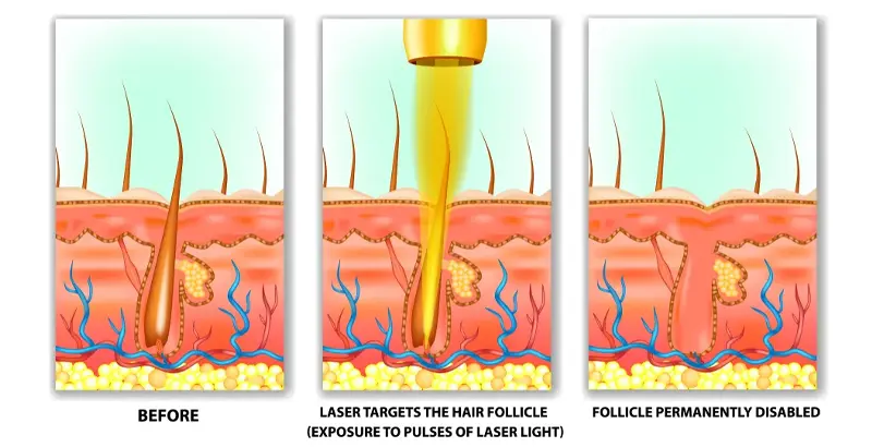 diode laser machine Working Principle