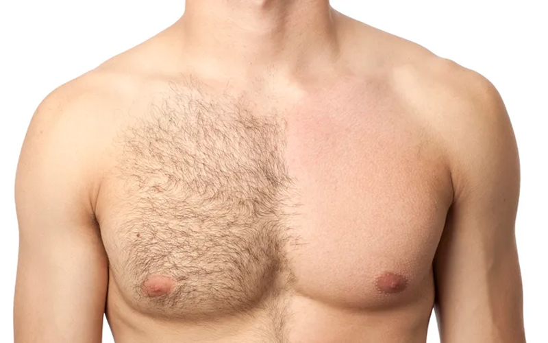 SHR Hair Removal Machine Applications