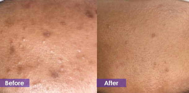 CO2 laser acne scar removal treatment result