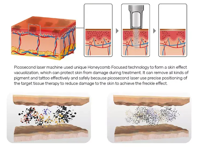 Q-switched Nd:YAG laser Working Principle
