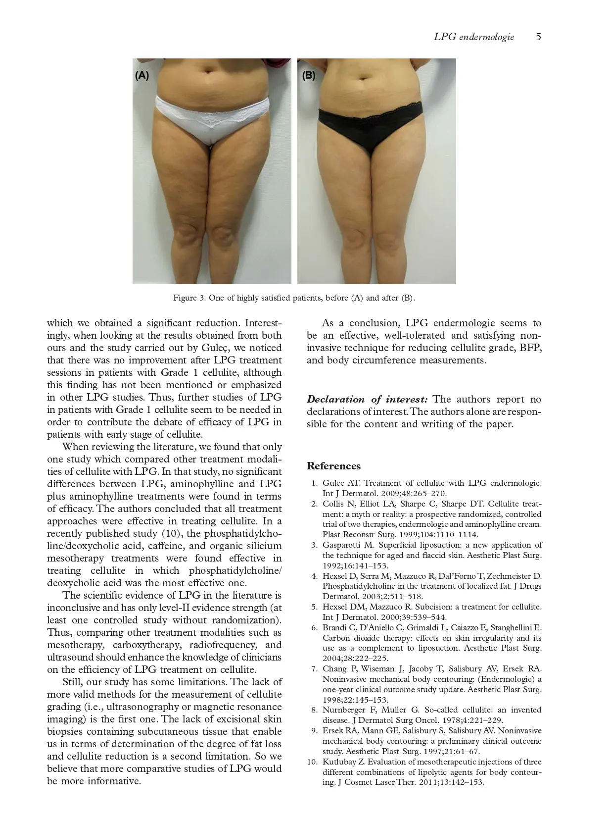 An alternative treatment modality for cellulite LPG endermologie