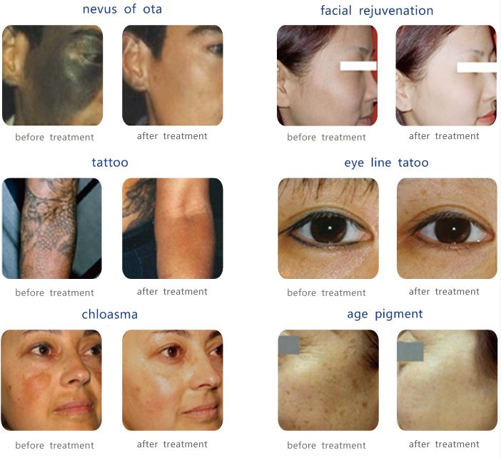 tattoo removal treatment before and after