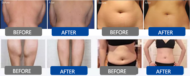 pressotherapy machine before and after