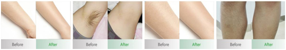 Hair Removal Treatment