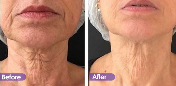 Neck firming before and after