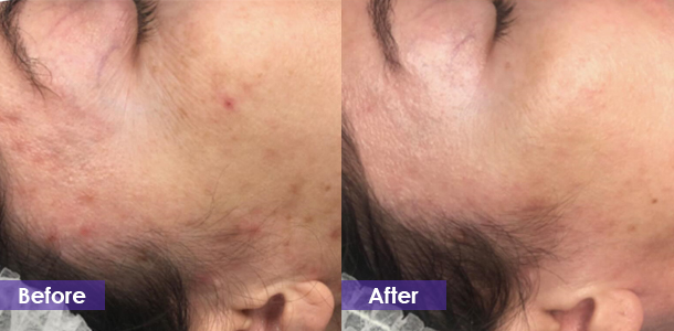 Morpheus8 Acne Treatment before and after