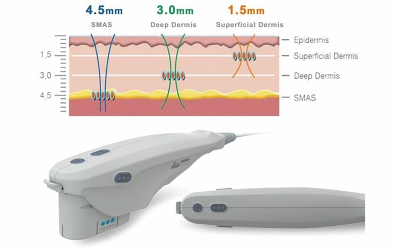 What is SMAS?