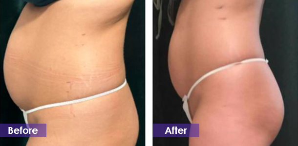 Abdominal fat reduction before and after