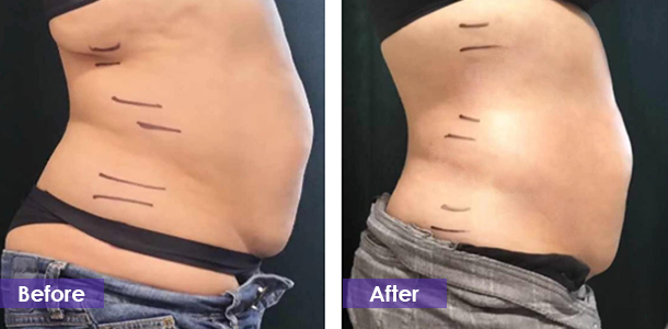 Waist tightening before and after