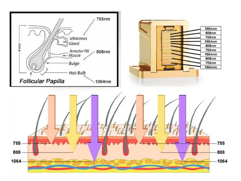 Diode Laser Hair Removal Machine Working Principle