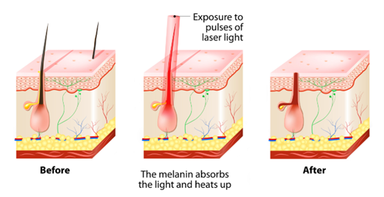 How hair removal works
