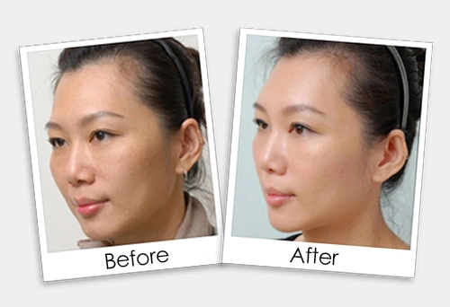 IPL Pigments tremoval treatment