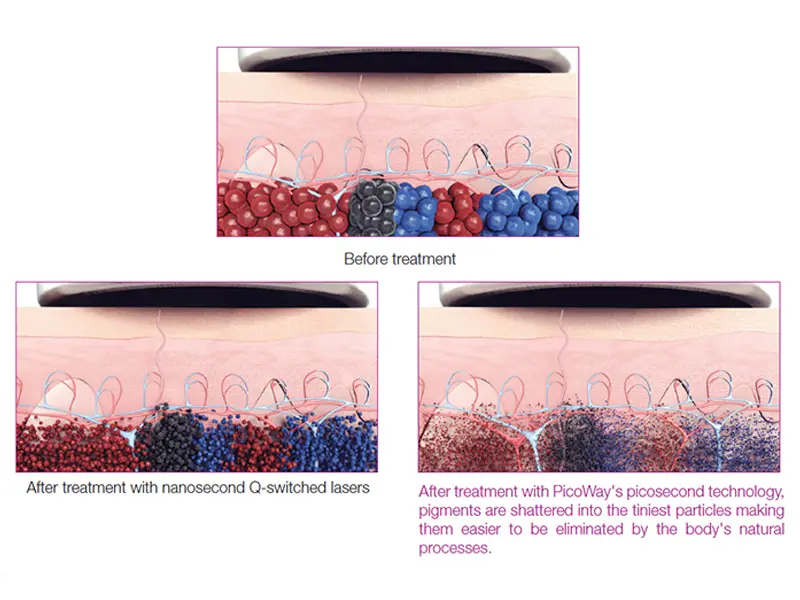 Picosecond laser tattoo removal Working principle
