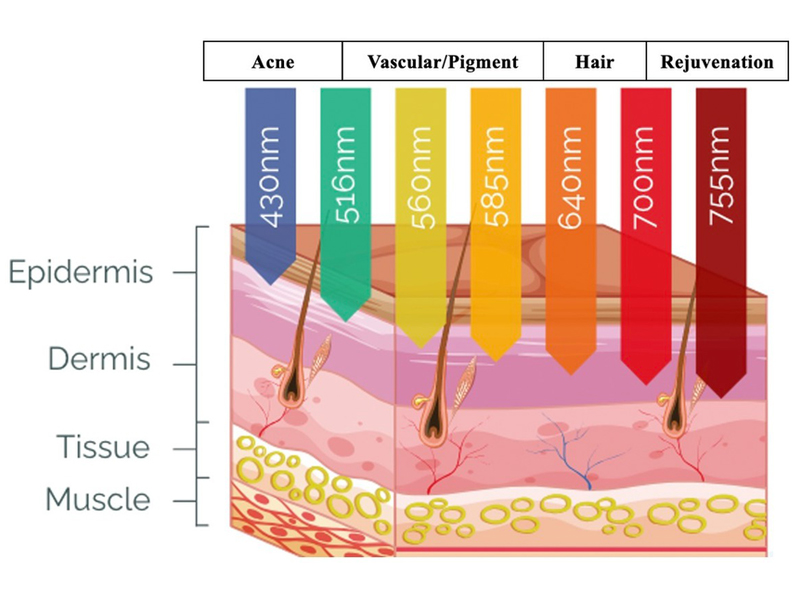 IPL Laser Working Principle