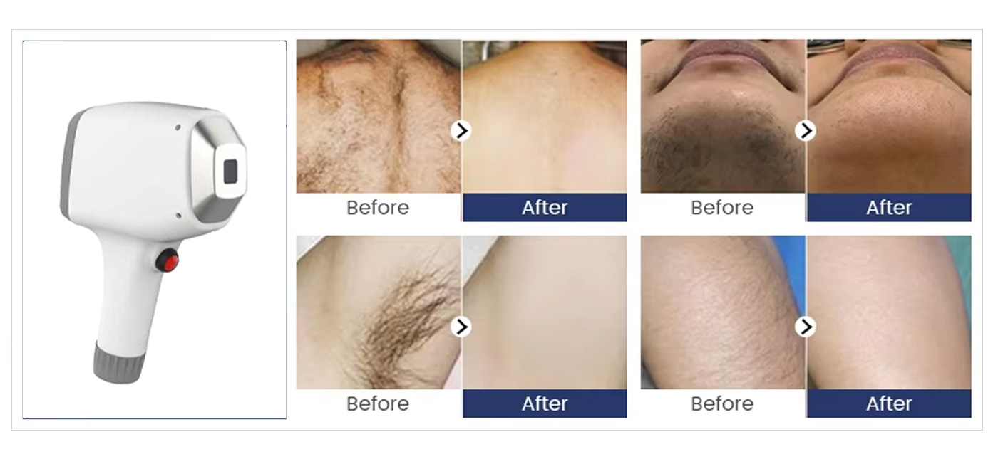Before and after hair removal photos