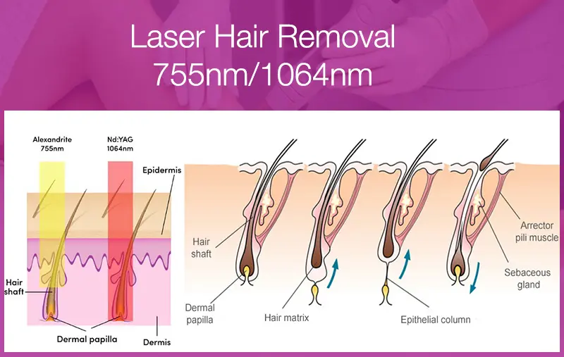 755nm Alexandrite laser machine Working Principle