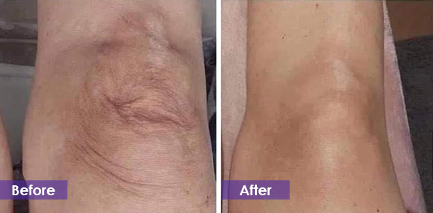 ght legs before and after