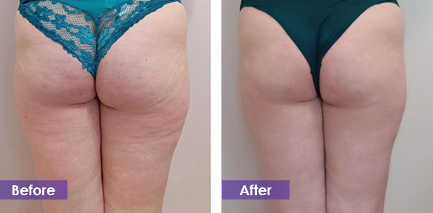 Cellulite Reduction before and after
