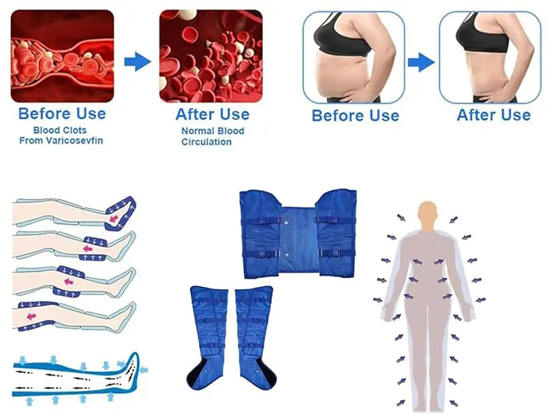How pressotherapy treatment?