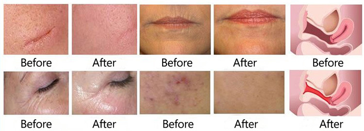 CO2 laser machine treatment before and after