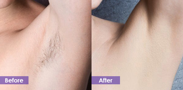laser hair removal before and after