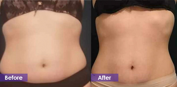 Abdominal firming before and after
