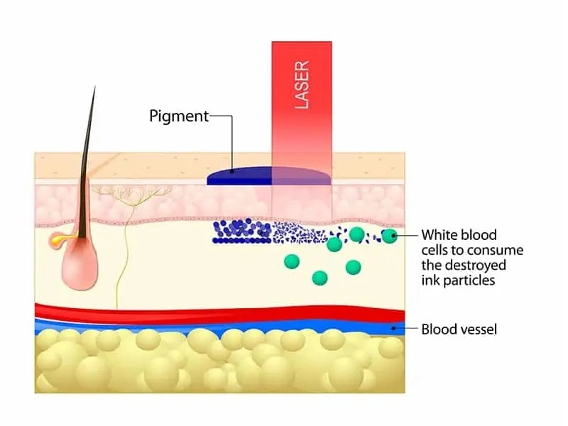 laser tattoo removal machine Working Principle
