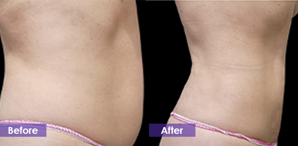 Abdominal fat reduction before and after