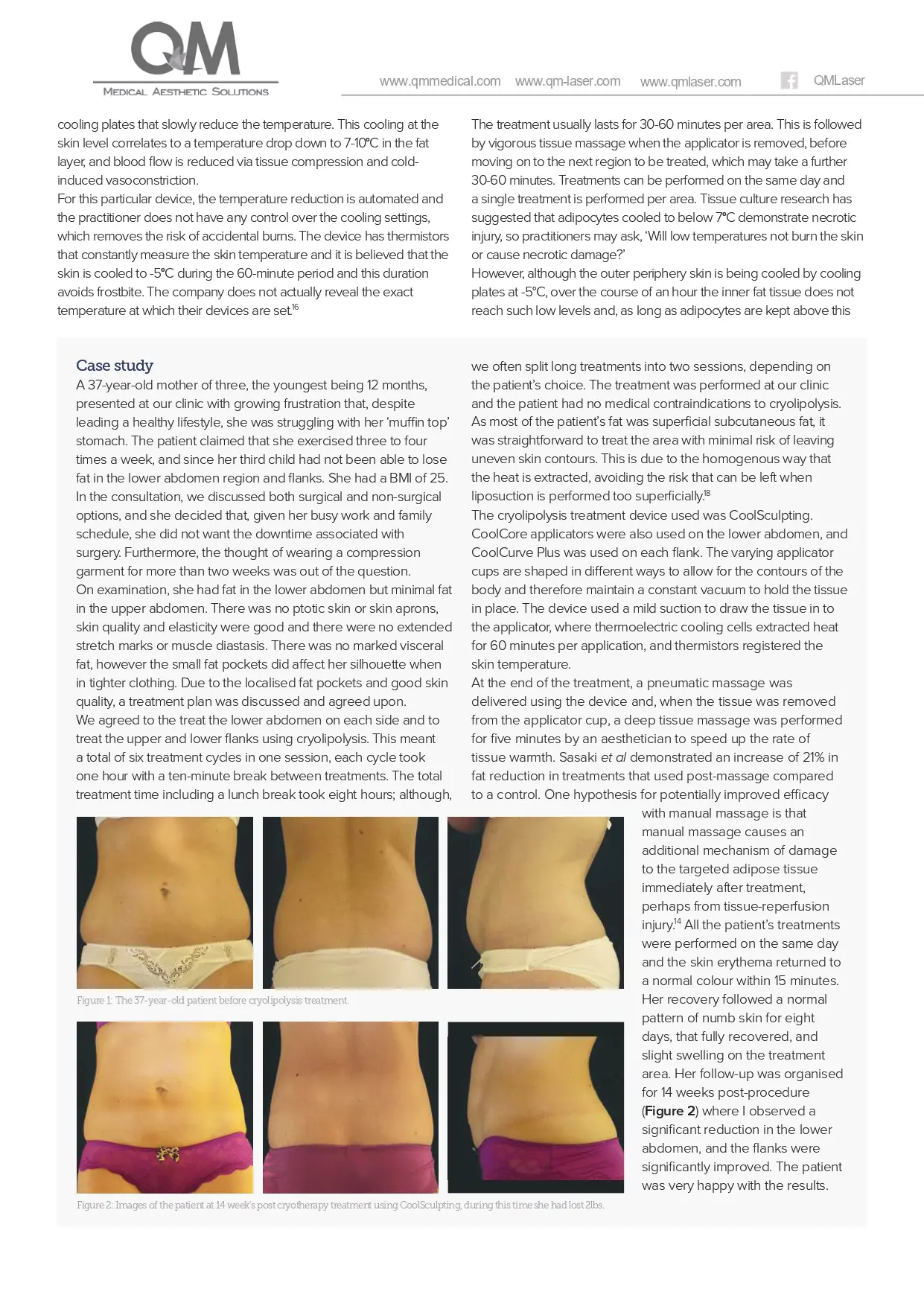 Body Contouring Using Cryolipolysis