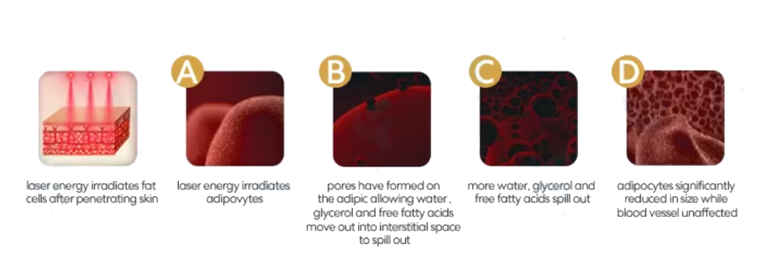 Laser Lipo Technology