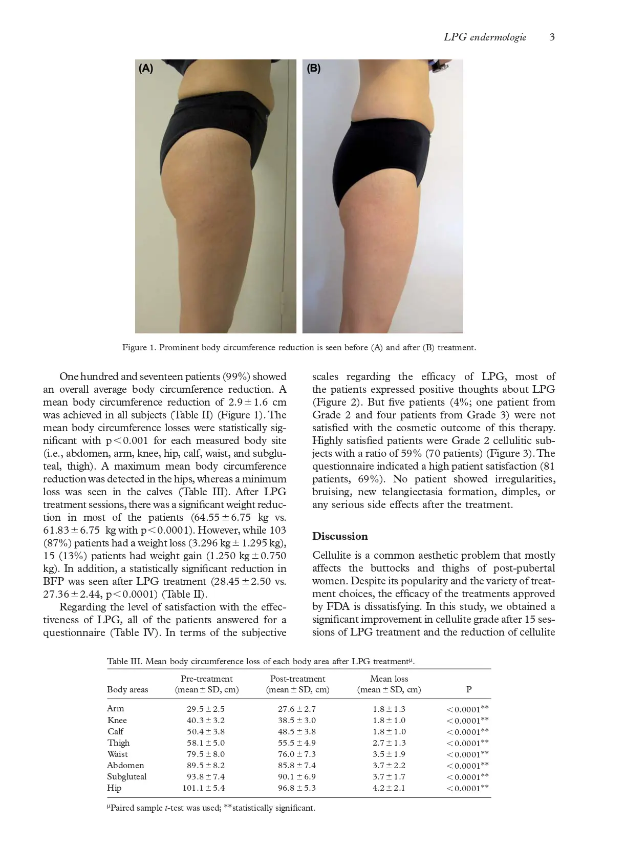 An alternative treatment modality for cellulite LPG endermologie