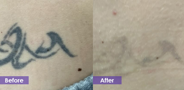 Small tattoo removal before and after