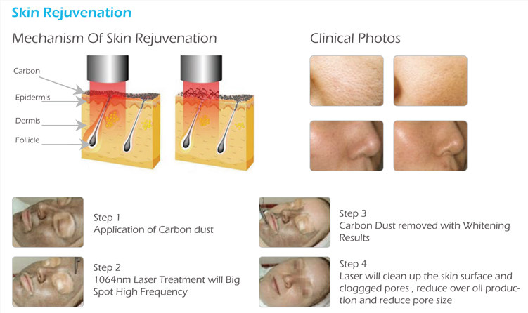 How does Carbon Peel treatment?