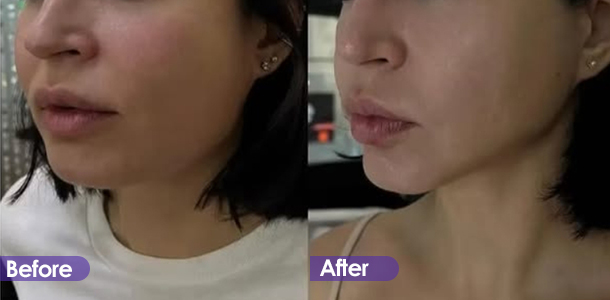 Jawline tightening treatment