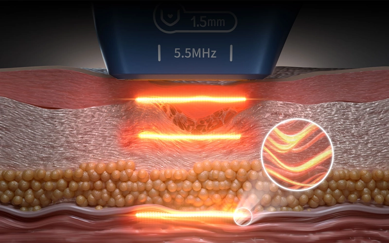 ULTRAMICRO PULSE ULTRASONIC SYSTEM