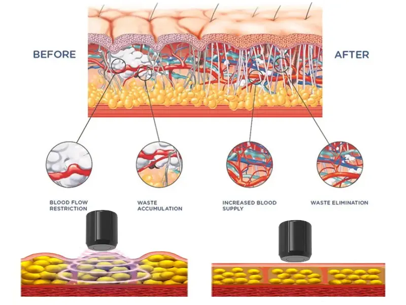 How Smart Tecar Shockwave works?