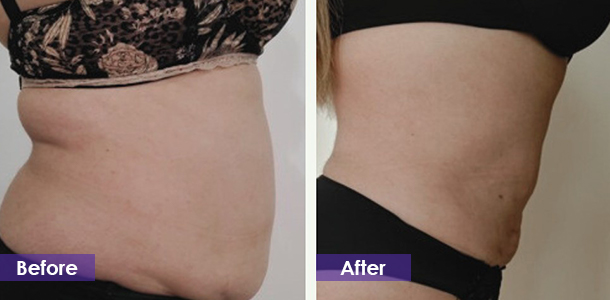cryo for treatment Abdominal