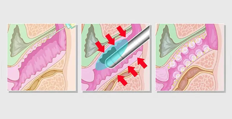 HIFU Vaginal Tightening Machine Working Principle