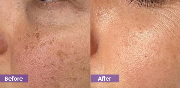 Facial spot removal before and after