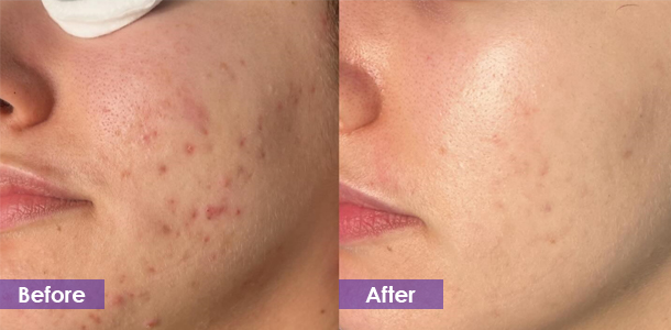 CO2 laser face acne scar removal treatment result