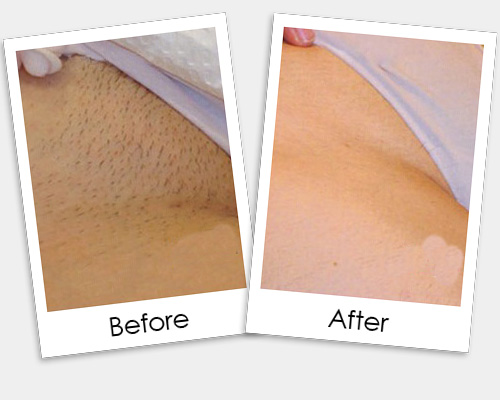Bikini Hair Removal Treatment