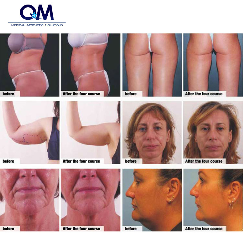 BTL 6000 Exilis Before & After