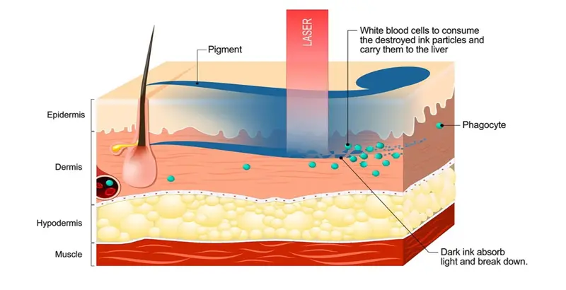How does laser tattoo removal work?