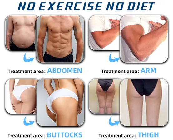Portable Emsculpting Muscle Sculpting Machine Before and After