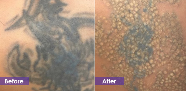 Large tattoo removal before and after