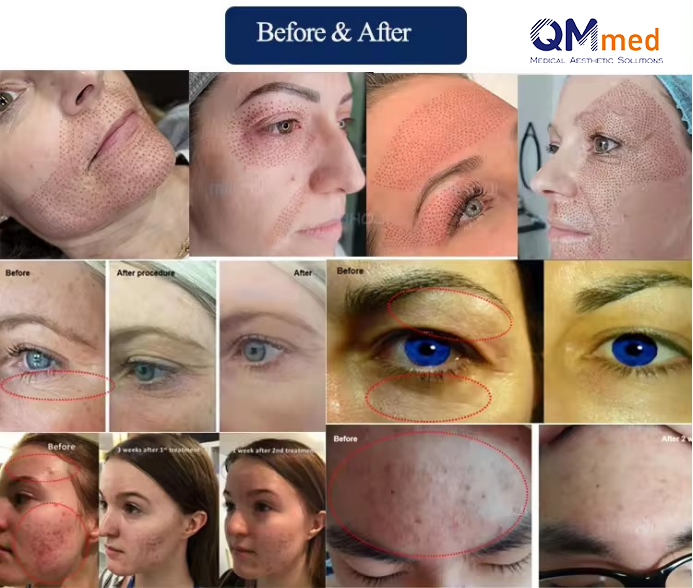 Portable Fusion Plasma Machine Before & After